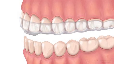 TMJ Splints: Relief from temporomandibular joint disorders | Alpine BioDental