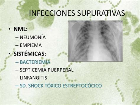 Tromboflebitis séptica sural por S pyogenes PPT