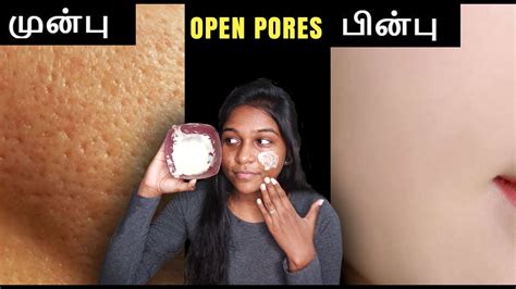 How To Get Rid Of Large Open Pores In 3 Steps Open Pores Home Remedy