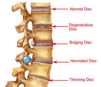 Signs and Symptoms of Bulging Disc - Bye Bye Lower Back Pain