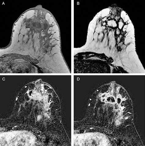 References In Chronic Granulomatous Mastitis Imaging Pathology And Management European