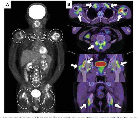 Figure From Diagnostic Fdg Pet Ct Findings In Polymyalgia Rheumatica