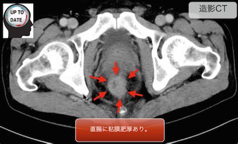 潰瘍性大腸炎とは？症状は？ct画像診断のポイントは？ 画像診断まとめ