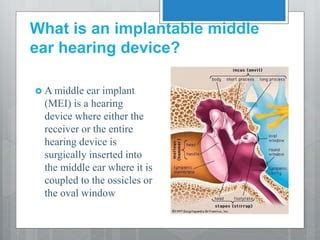 MIDDLE EAR IMPLANTS ppt new.pptx