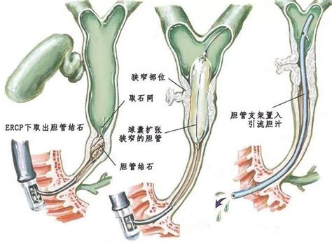 膽結石有哪些治療方法？帶你了解自己的身體 每日頭條