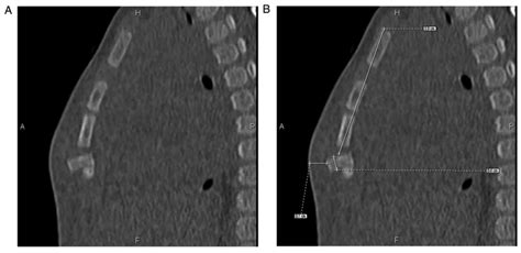 Role Of Ultrasound And Ct In The Early Diagnosis And Surgical Treatment