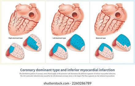 Inferior Infarct Images Stock Photos Vectors Shutterstock