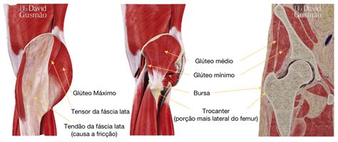 Bursite De Quadril Trocant Rica Dr David Gusm O Especialista Em