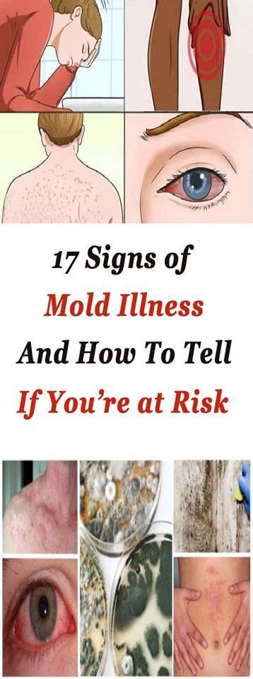 17 Signs Of Mold Illness And How To Tell If You’re At Risk Health Symptoms Of Mold Sinus