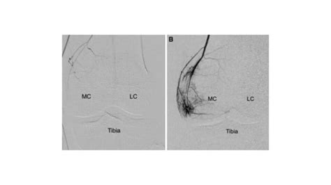 Genicular Artery Embolization Gae