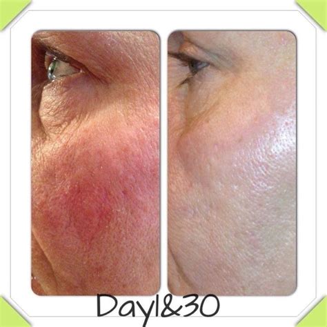 Nerium Beforeafter Pictures Nerium