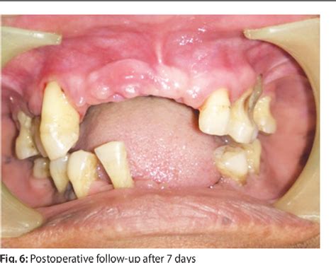 Figure 6 From A Case Report On Epulis Fissuratum Semantic Scholar