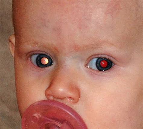 Retinoblastoma: Symptoms, Diagnosis And Treatment