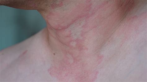 Hives: Causes, Risks, Prevention, and Pictures