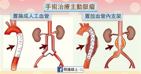 致命的炸彈 主動脈瘤（懶人包） 照護線上