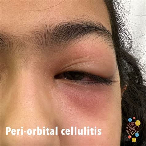 Preseptal Cellulitis