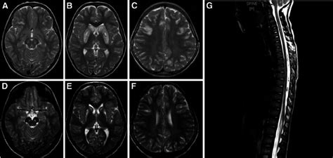 Mri Brain Axial T Weighted Spin Echo Images Images A To F And Mri