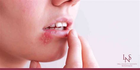 Herpes Zoster O Que é e Como Prevenir