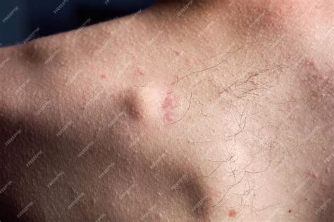 Premium Photo Small Round Lipoma On The Upper Back Of Young Caucasian