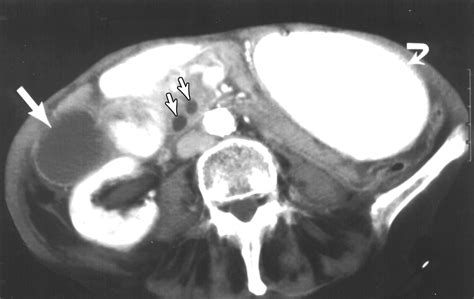 Spontaneous Intramural Small Bowel Hematoma Imaging Findings And