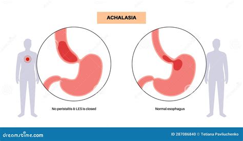 Esophageal Achalasia Disease Cartoon Vector | CartoonDealer.com #287414249