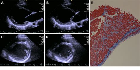 Figure 1 From Congenital Contractural Arachnodactyly Without Fbn1 Or Fbn2 Gene Mutations