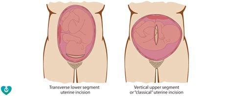 Mercy Perinatal