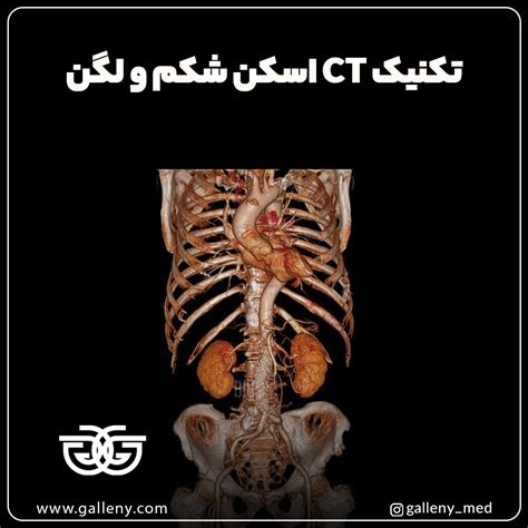 تکنیک Ct اسکن شکم و لگن گالنی