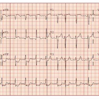 The Electrocardiogram Shows St Segment Elevation In Lead Avl And V