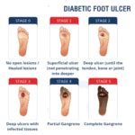 Diabetic Feet Pictures - Net Patient Foundation