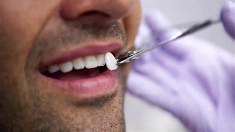 Soluciones Para Una Sonrisa Perfecta Clínica Dental San Basilio Murcia