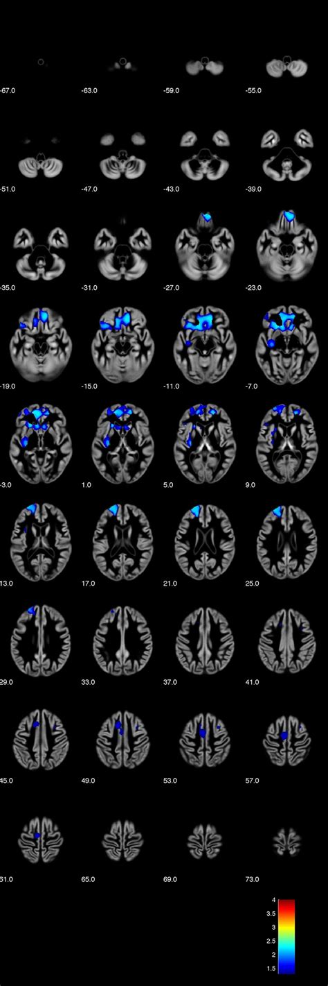 Voxel Based Morphometry VBM Analysis Showing Positive Correlations Of