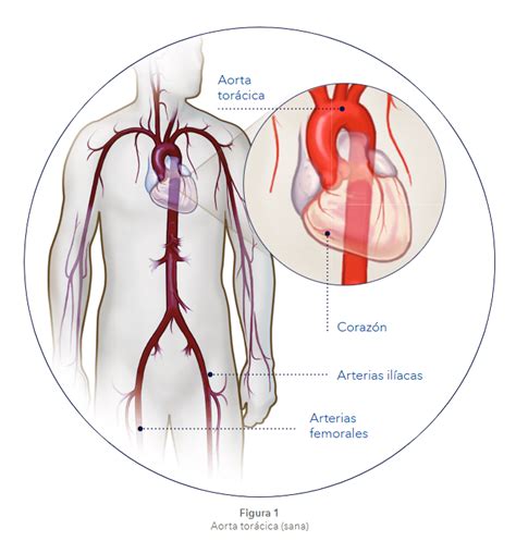 Qué es la aneurisma aórtico torácico Cuidando Tu Corazón