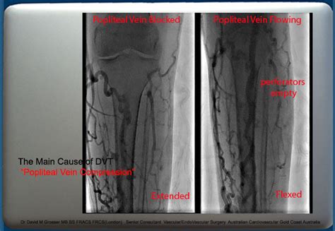 Popliteal vein compression syndrome the MAIN cause of DVT, unrecognise