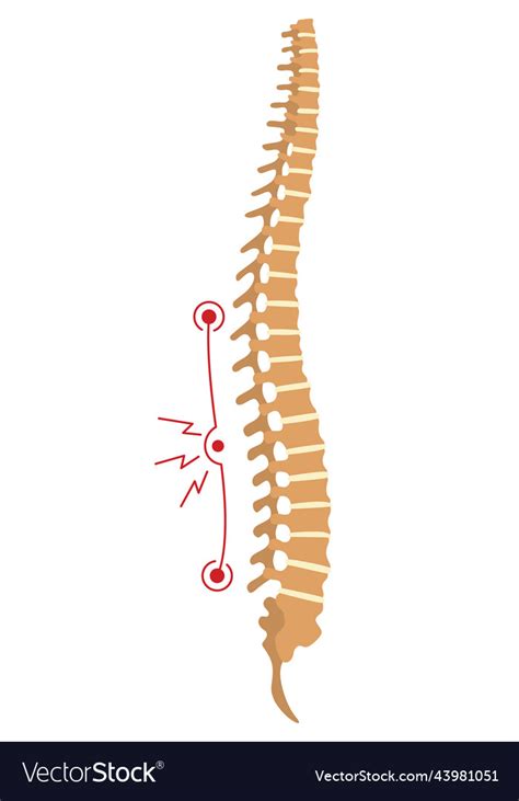 Spinal Deformity Symbol Of Spine Curvatures Vector Image