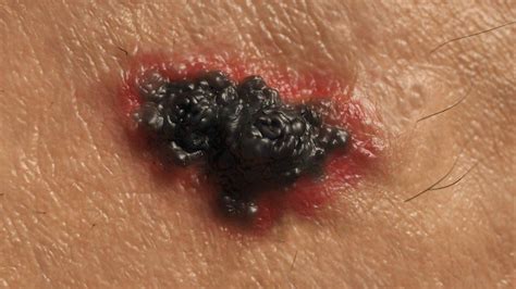 Skin cancer: Half of people surviving advanced melanoma - BBC News