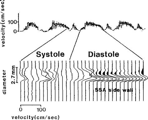 Figure 2 From Comparison Of Blood Flow Velocity Waveforms Semantic