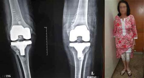 Total Knee Replacement Surgery Pictures Knee Specialist In Mumbai Dr Amyn Rajani