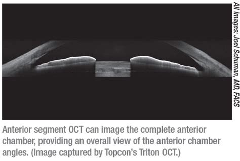 Anterior Segment OCT: Still Evolving