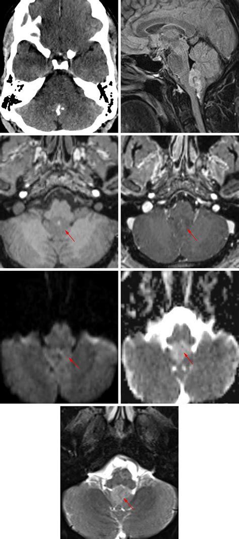 Subependymoma The Neurosurgical Atlas