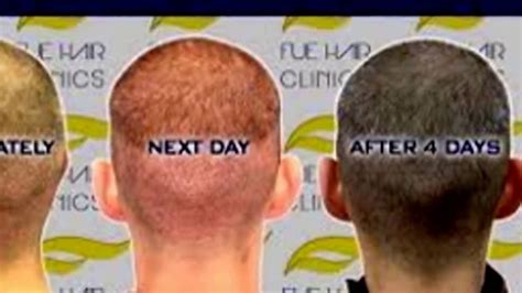 Hair Restoration Hair Regrowth Treatment Stem Cell Hair Restoration