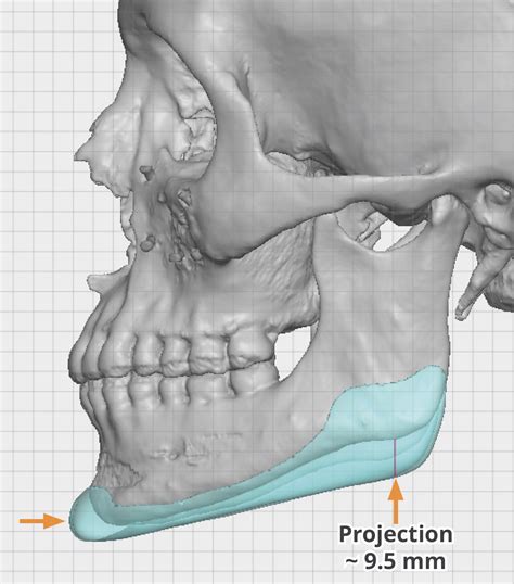 Plastic Surgery Case Study The Necklifting Effect Of The Vertical