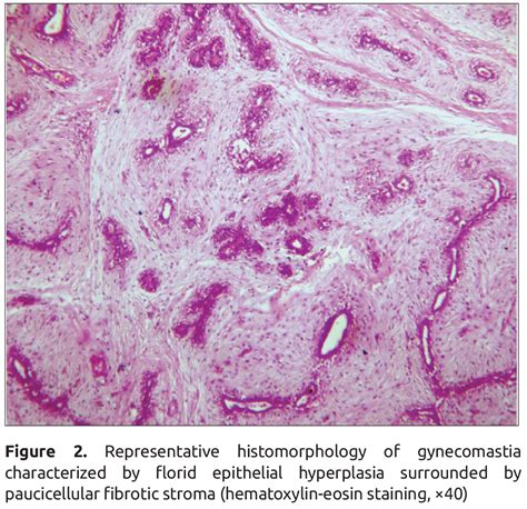 Cytological Evaluation Of Pathological Male Breast Lesions European Journal Of Breast Health