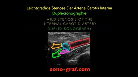 Duplexsonographie Leichtgradige Stenose Der Arteria Carotis Interna