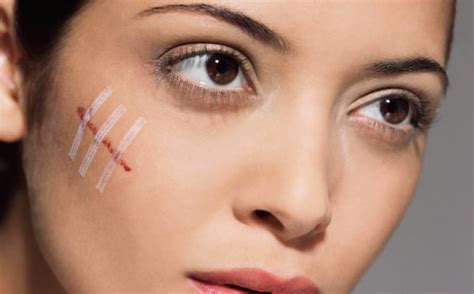 Scars Explained Definition Types Treatments Cell