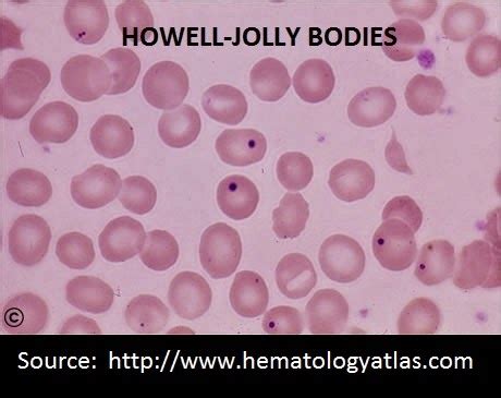 Lab Atlas: Howell Jolly Bodies