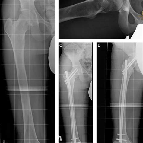 Symptomatic Fibrous Dysplasia Of The Proximal Right Femur In An