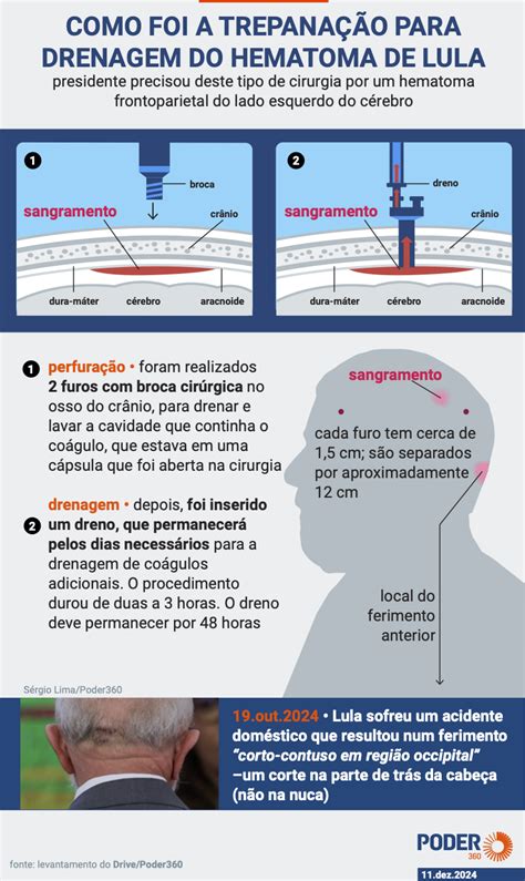 Leia a íntegra do boletim médico de Lula deste sábado