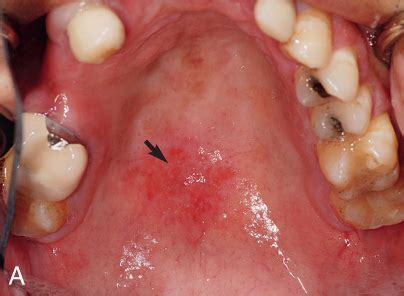 Chapter 41 Fixed And Removable Dental Prosthesis Flashcards Quizlet