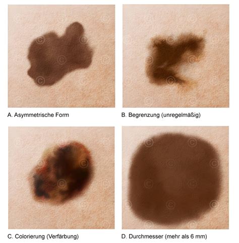 Illustrationen Erkennung Hautkrebs Medicalgraphics